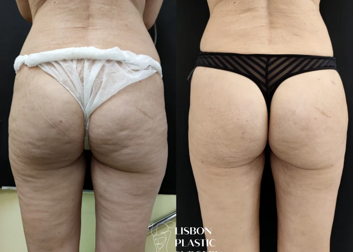 Lipolaser 2