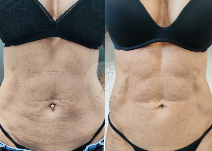 Lipolaser 3