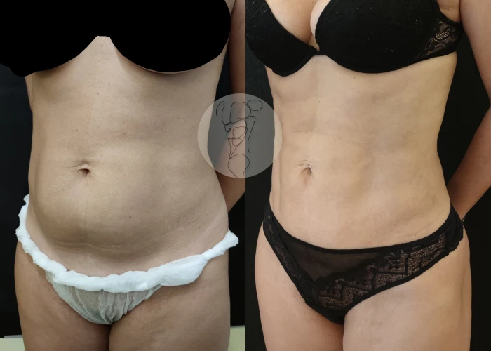 Lipolaser 4