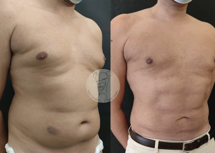 Lipolaser 5