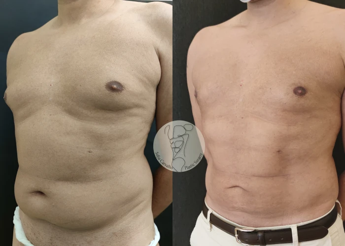 Lipolaser 6